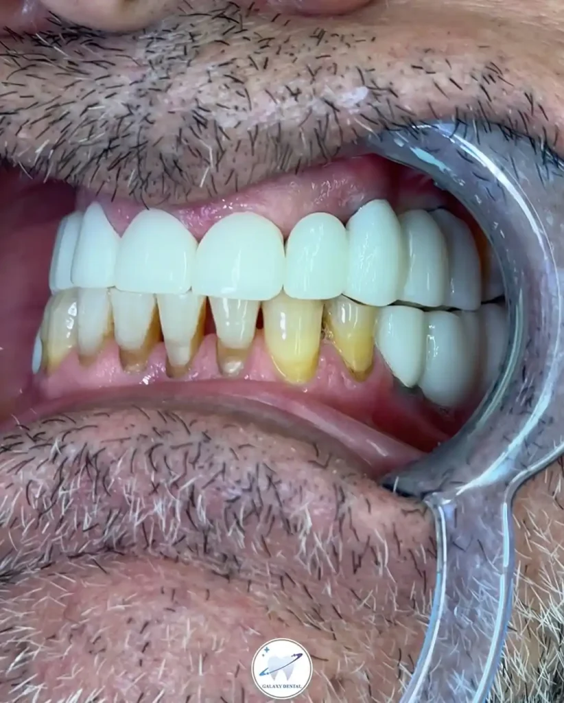 ایمپلنت بدون جراحی بعد